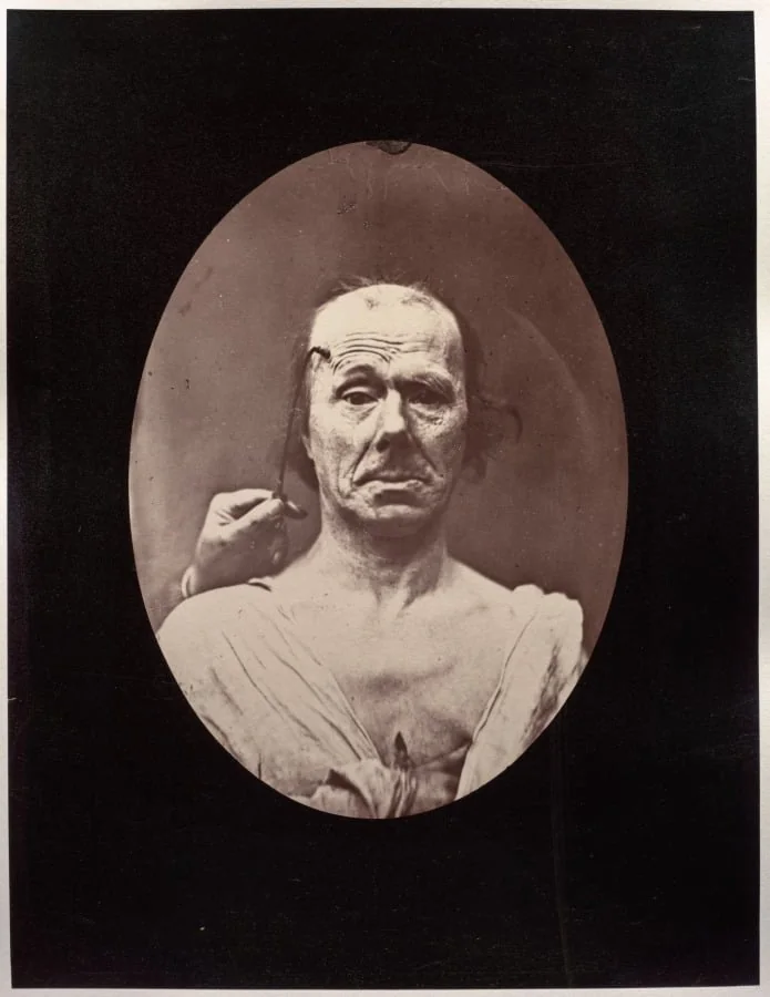 Figure 7: Étude du méchanisme et de l'expression du muscle frontal chez un vieillard: à droit, attention; à gauche, repos, detail