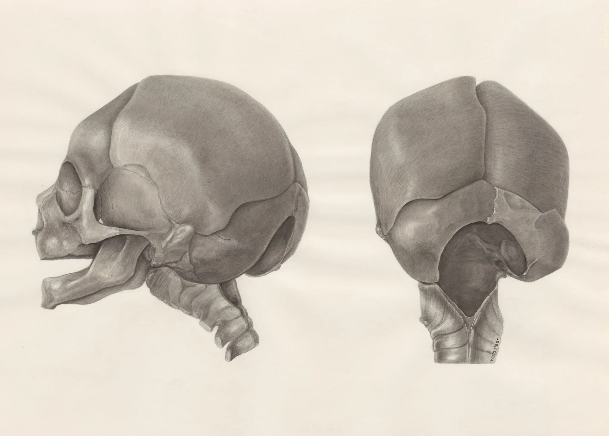 Deformed fetal skull, with part of the spinal cord, detail