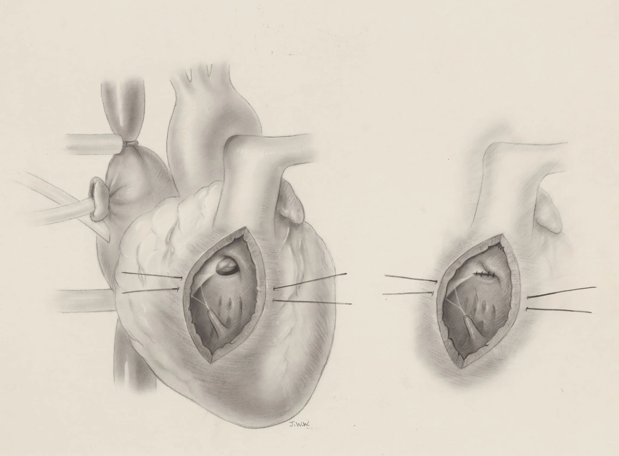 Ventricular septal, detail