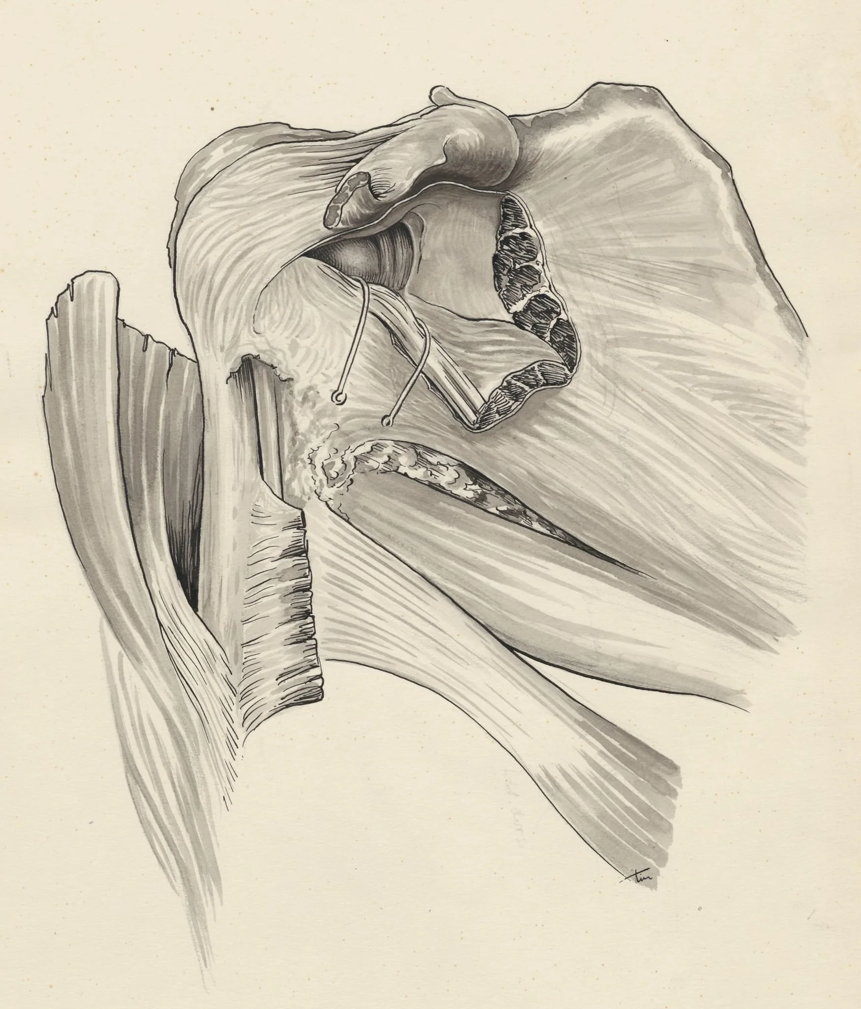 Damage of the pelvic bones, detail