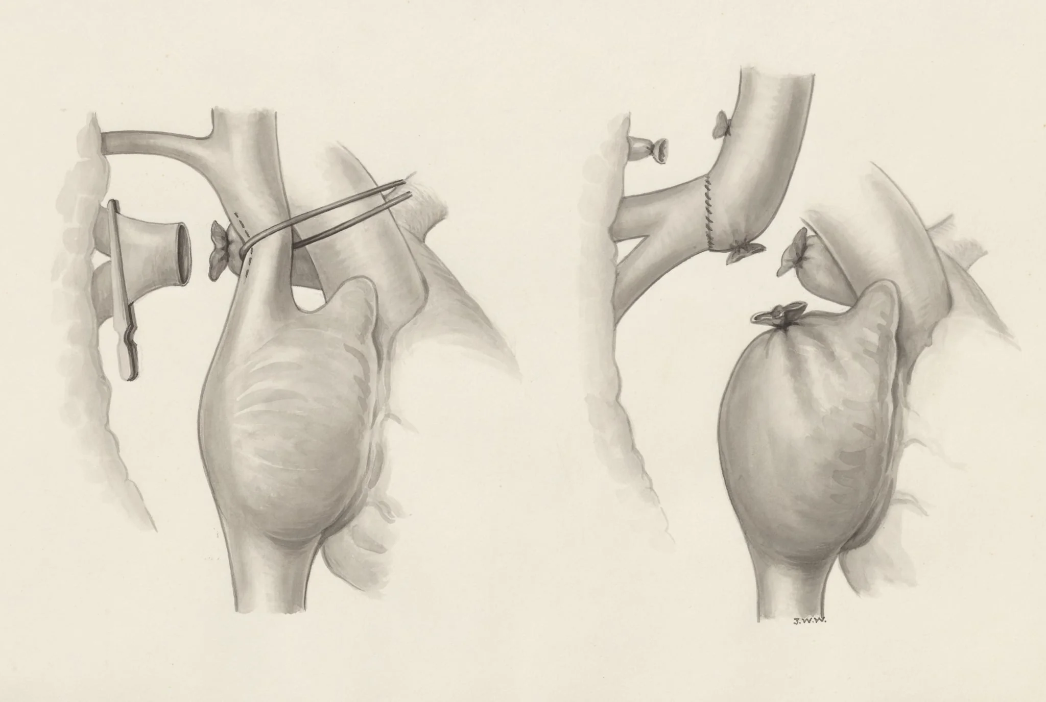 Heart surgery, detail