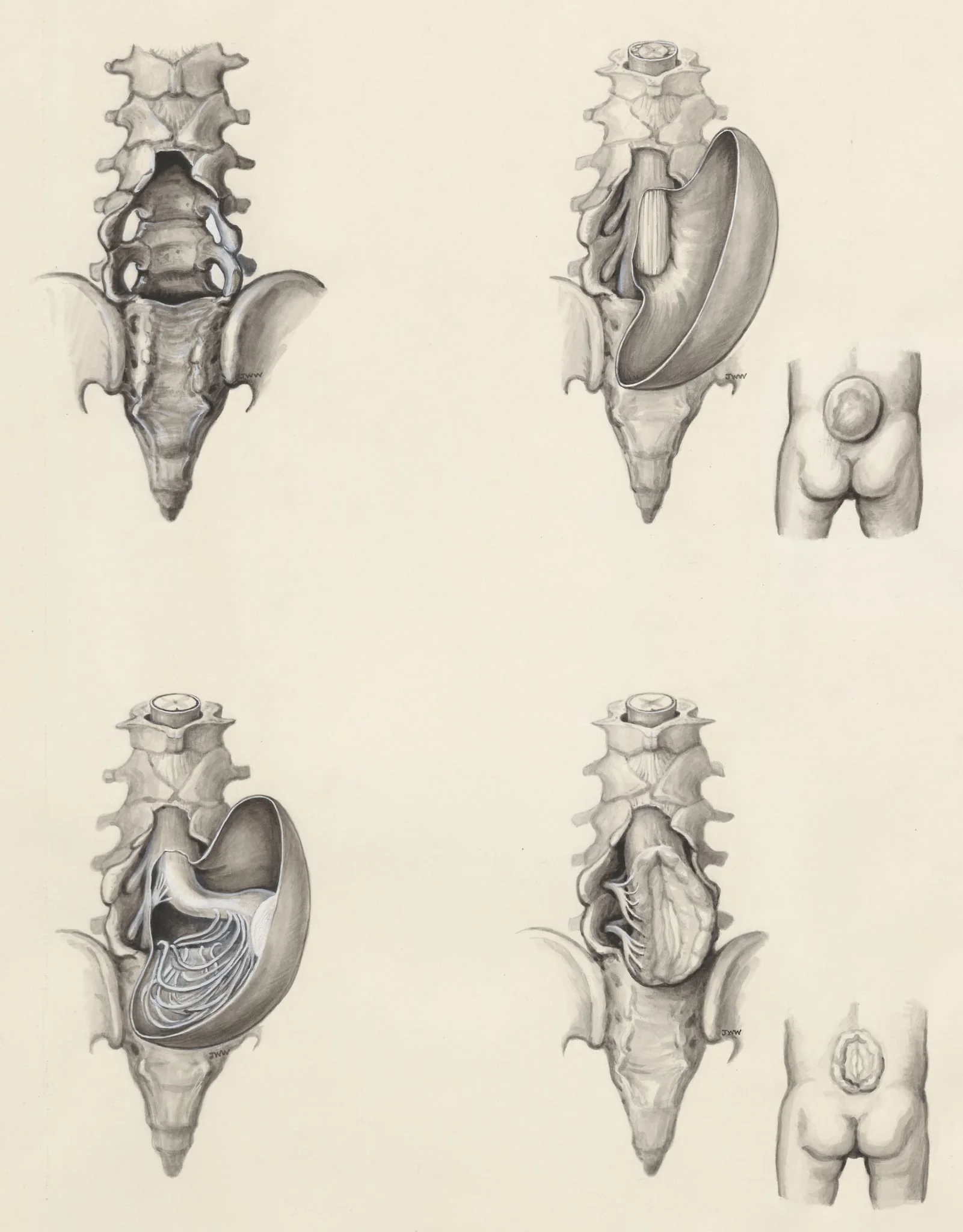 Protrusion of the lower back, detail