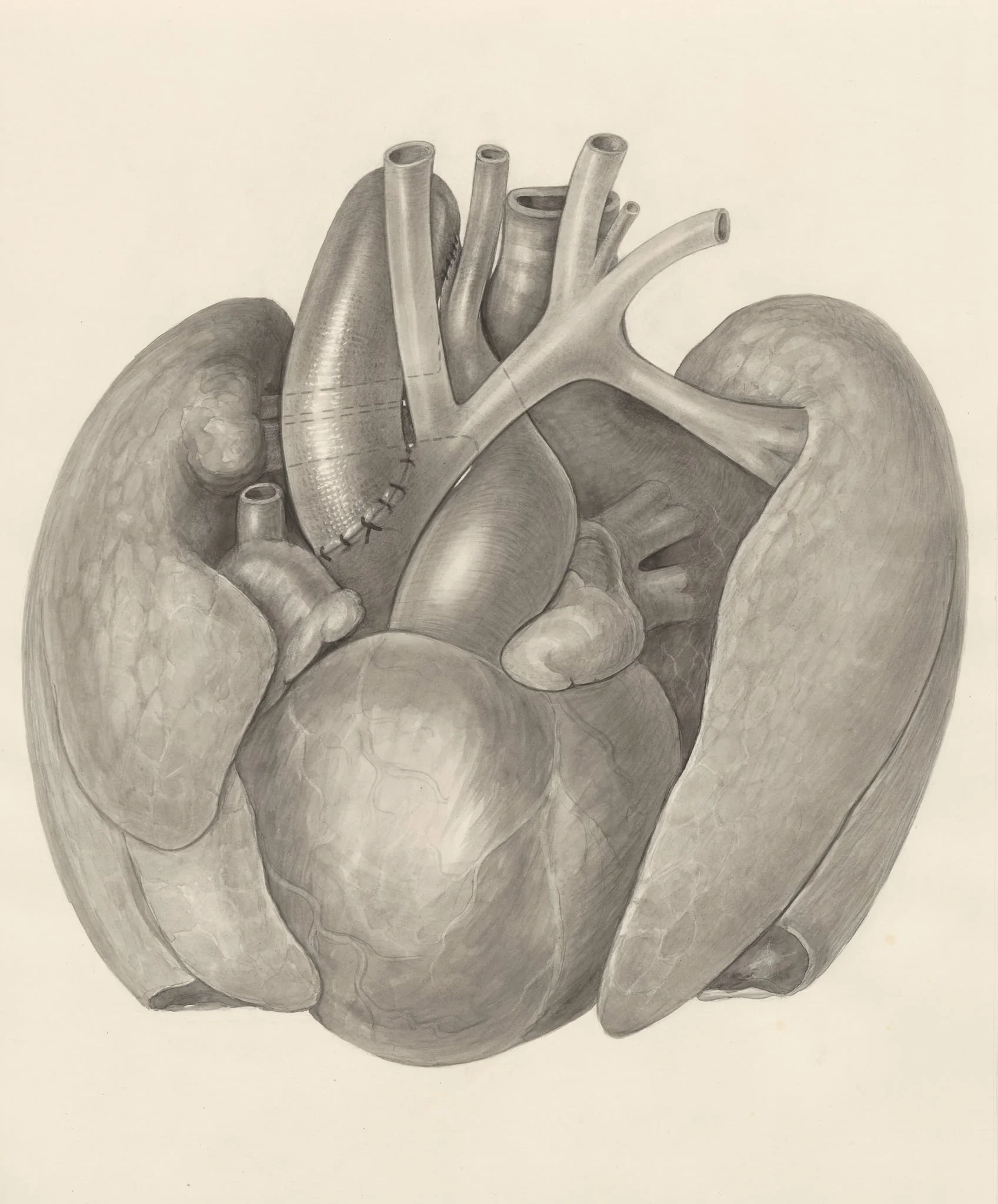 Surgical procedure on a heart and adjacent organs, detail