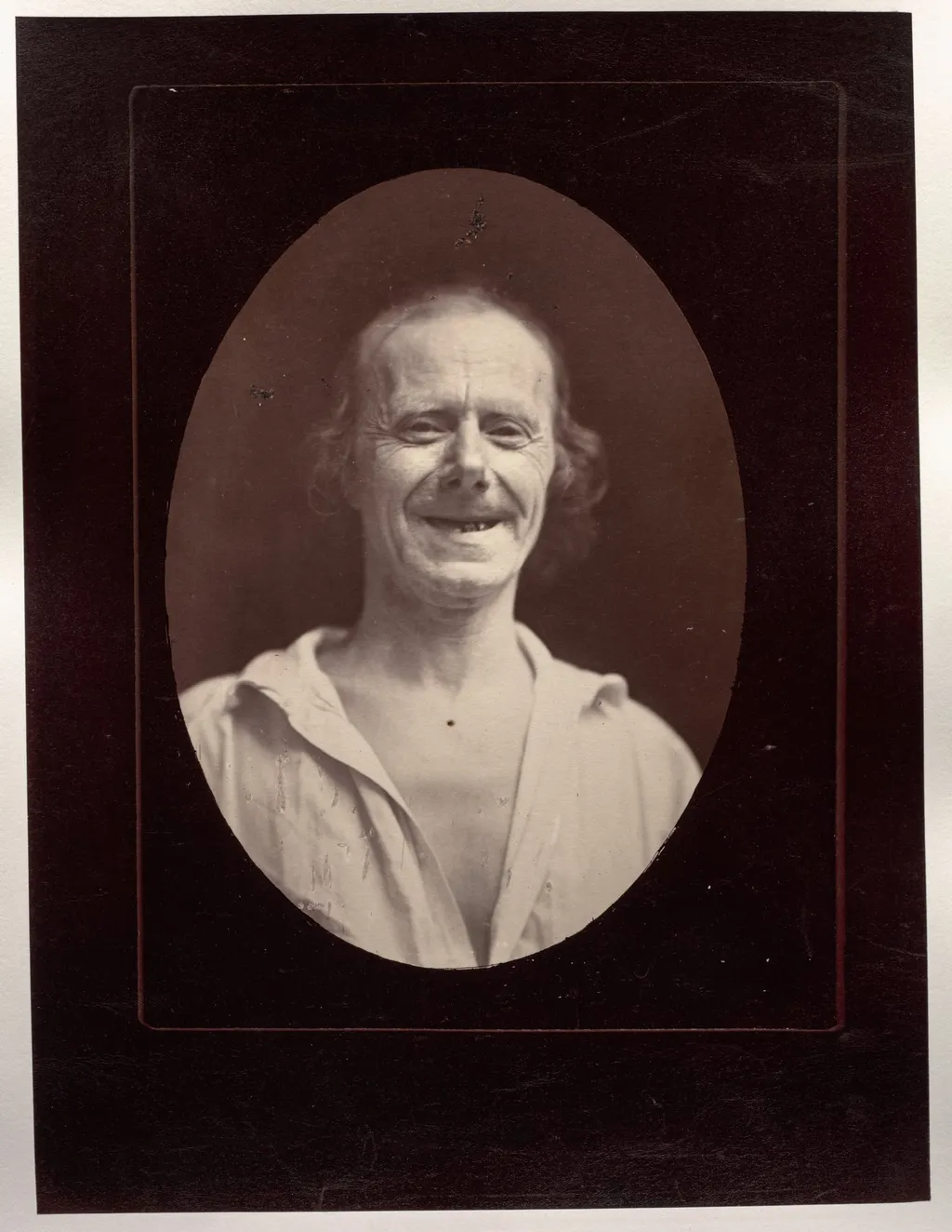 Figure 32: Natural laughter by the voluntary contraction of the two large zygomatics and the lower palpebral orbicularis, by Guillaume-Benjamin-Amand Duchenne (de Boulogne), 1856