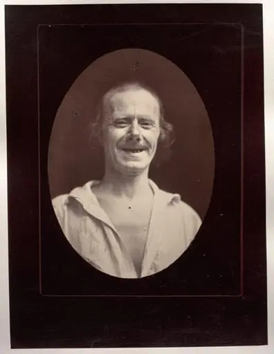 Figure 32: Natural laughter by the voluntary contraction of the two large zygomatics and the lower palpebral orbicularis, by Guillaume-Benjamin-Amand Duchenne (de Boulogne)