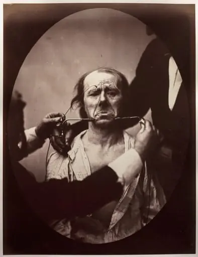 Figure 45: Contraction électrique forte des triangulaires des lèvres et des sourciliers: douleur et déspoir, by Guillaume-Benjamin-Amand Duchenne (de Boulogne)