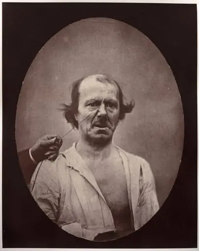 Figure 51: À droite, contraction partielle de l'élévateur commun de l'aile du nez et de la lèvre supérieure: mécontentement, mauvaise humeur; à gauche, repos, by Guillaume-Benjamin-Amand Duchenne (de Boulogne)