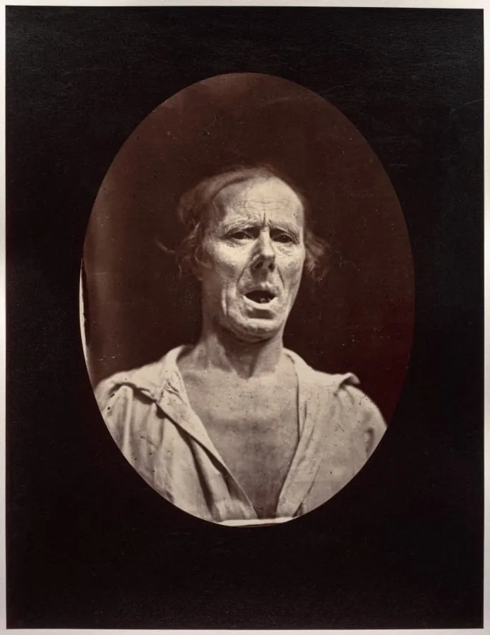 Figure 54: Abaissement volontaire de la mâchoire inférieure: mouvement inexpressif, by Guillaume-Benjamin-Amand Duchenne (de Boulogne), 1856