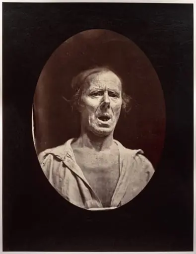 Figure 54: Abaissement volontaire de la mâchoire inférieure: mouvement inexpressif, by Guillaume-Benjamin-Amand Duchenne (de Boulogne)