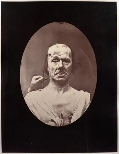 Figure 7: Étude du méchanisme et de l'expression du muscle frontal chez un vieillard: à droit, attention; à gauche, repos, by Guillaume-Benjamin-Amand Duchenne (de Boulogne)