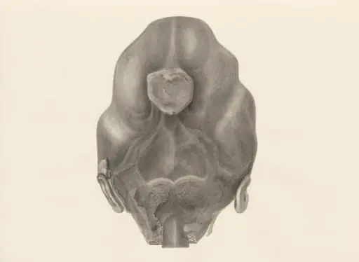 Deformed fetal head, seen from the back, by H.G, Wetselaar