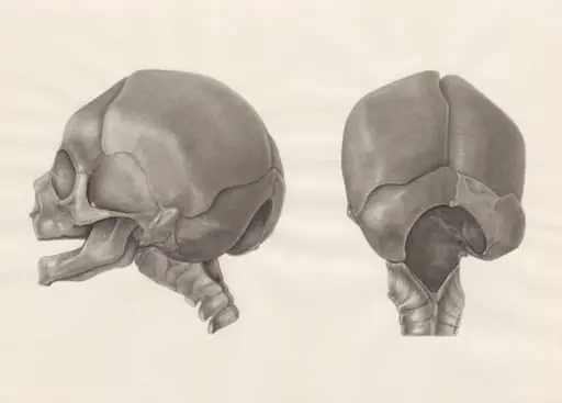Deformed fetal skull, with part of the spinal cord, by H.G, Wetselaar