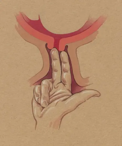 gynaecological procedure, two fingers penetrating the cervix, by J Tinkelenberg