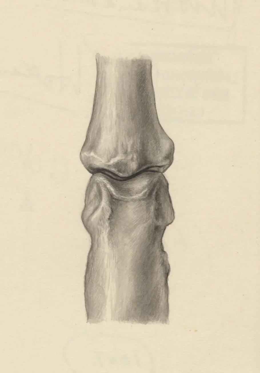 Joints of the hand or fingers, by J Tinkelenberg, 1953