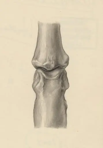 Joints of the hand or fingers, by J Tinkelenberg