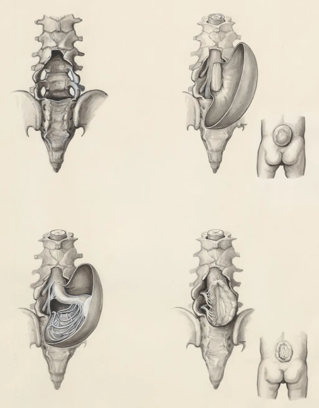 Protrusion of the lower back, by J Wetselaar-Whittaker, 1987