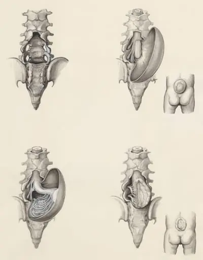 Protrusion of the lower back