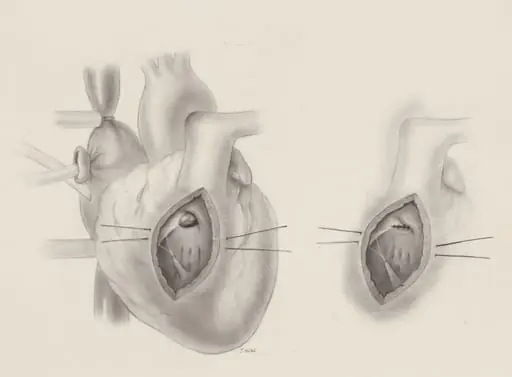Ventricular septal, by J Wetselaar-Whittaker